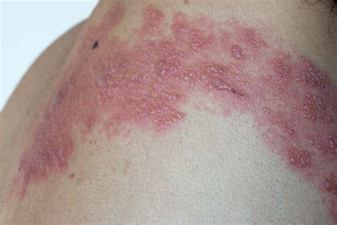 shingles armpit|Shingles Pictures: What the Shingles Rash Looks Like .